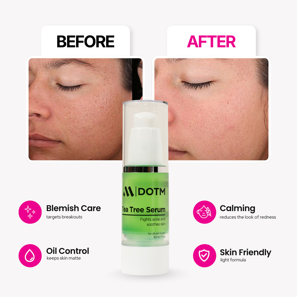 Teatree Serum